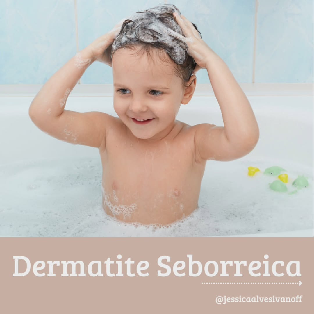 Dermatite Seborreica