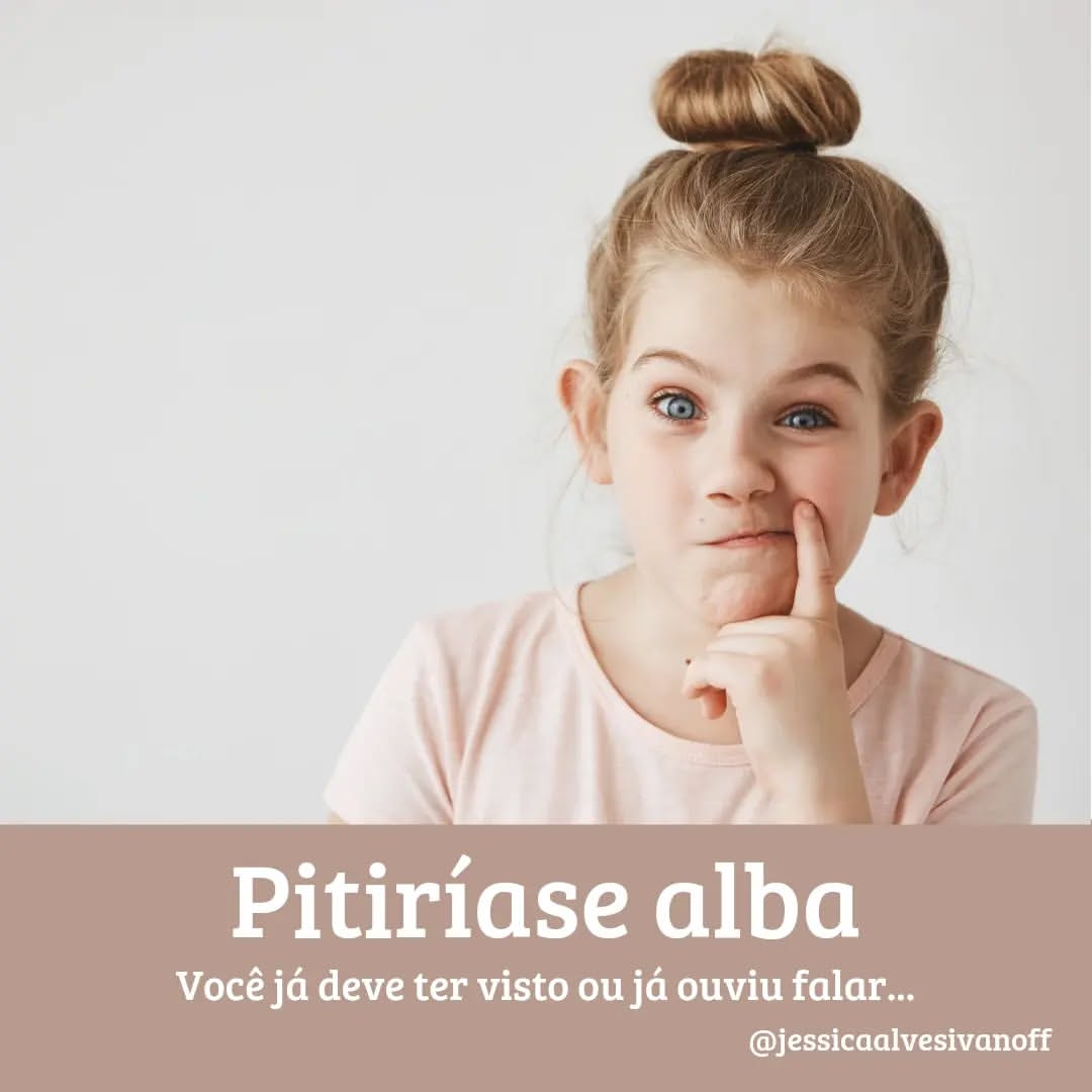 Pitiríase alba: você já deve ter visto ou já ouviu falar…